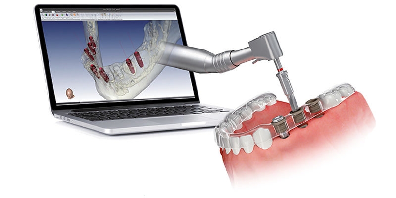 L implantologia guidata computer assistita rappresenta un